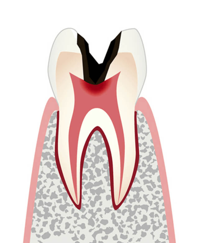 神経まで進行したむし歯のイラスト