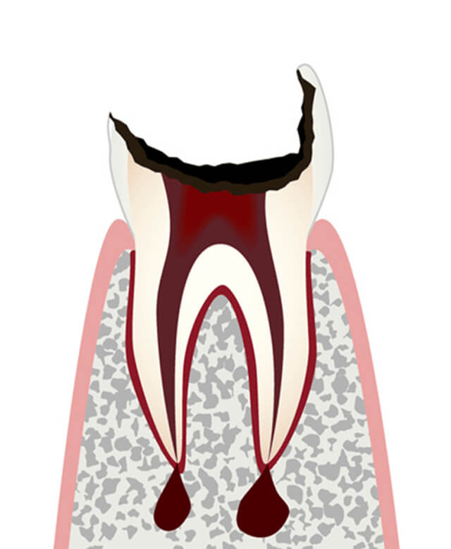 歯の根まで進行したむし歯のイラスト
