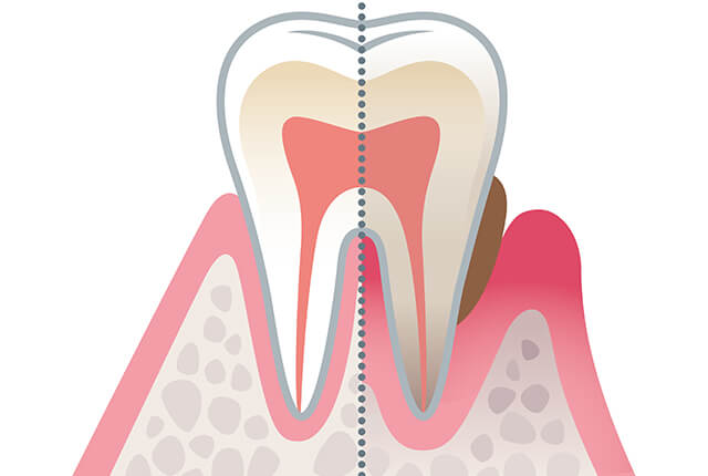 歯周病のイラスト